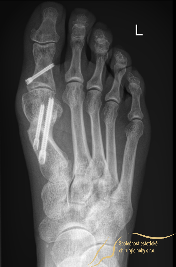 röntgenový snímok zahojených kostí vbočeného palca